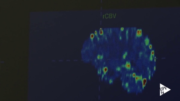 Tratamientos ms eficades de tumores cerebrales